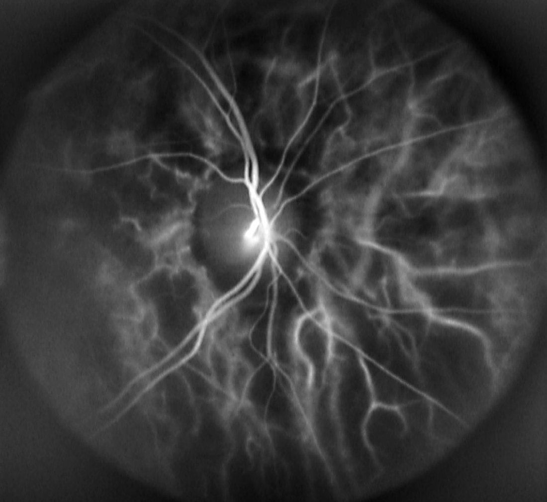 Human retinal perfusion captured with Laser Doppler Holography